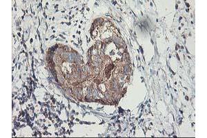 Immunohistochemical staining of paraffin-embedded Adenocarcinoma of Human breast tissue using anti-MTFMT mouse monoclonal antibody. (MTFMT Antikörper  (AA 175-389))