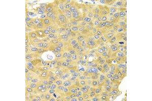 Immunohistochemistry of paraffin-embedded human liver cancer using PA2G4 Antibody (ABIN5973112) at dilution of 1/100 (40x lens). (PA2G4 Antikörper)
