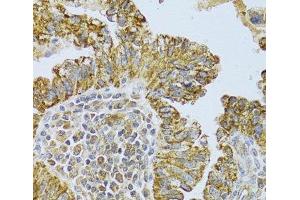 Immunohistochemistry of paraffin-embedded Human endometrial cancer using DLD Polyclonal Antibody at dilution of 1:100 (40x lens). (DLD Antikörper)