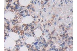 Detection of MHCC in Human Skin cancer Tissue using Polyclonal Antibody to Major Histocompatibility Complex Class I C (MHCC) (MHCC (AA 48-305) Antikörper)