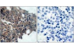 Immunohistochemistry analysis of paraffin-embedded human breast carcinoma, using p21 Cip1 (Phospho-Thr145) Antibody. (p21 Antikörper  (pThr145))