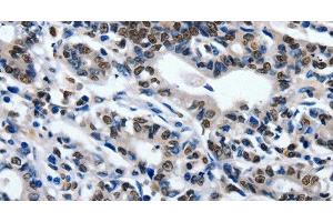 Immunohistochemistry of paraffin-embedded Human gasrtic cancer tissue using CD203c Polyclonal Antibody at dilution 1:80 (ENPP3 Antikörper)