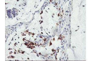 Immunohistochemical staining of paraffin-embedded Adenocarcinoma of Human colon tissue using anti-SDS mouse monoclonal antibody. (serine Dehydratase Antikörper)