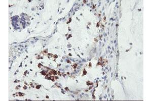 Immunohistochemical staining of paraffin-embedded Adenocarcinoma of Human colon tissue using anti-SDS mouse monoclonal antibody.
