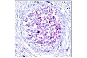 Immunohistochemical analysis of paraffin-embedded human breast carcinoma tissue using Raf1(Phospho-Ser259) Antibody. (RAF1 Antikörper  (pSer259))