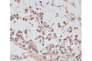 Immunohistochemistry of paraffin-embedded Human gastric cancer using PRPF31 Polyclonal Antibody at dilution of 1:100 (40x lens). (PRPF31 Antikörper)