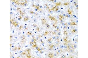 Immunohistochemistry of paraffin-embedded Human liver damage using WNT2 Polyclonal Antibody at dilution of 1:200 (40x lens). (WNT2 Antikörper)