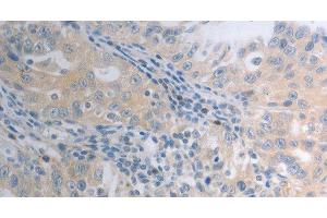 Immunohistochemistry of paraffin-embedded Human ovarian cancer tissue using SHH Polyclonal Antibody at dilution 1:40 (Sonic Hedgehog Antikörper)