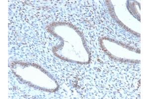 Formalin-fixed, paraffin-embedded human Endometrial Carcinoma stained with TLE1 Rabbit Recombinant Monoclonal Antibody (TLE1/2946R). (Rekombinanter TLE1 Antikörper  (AA 175-338))