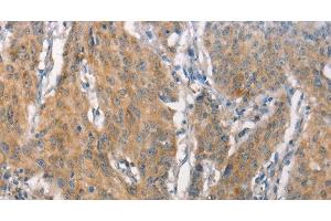 Immunohistochemistry of paraffin-embedded Human gastric cancer tissue using CEACAM6 Polyclonal Antibody at dilution 1:50