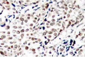 Immunohistochemistry (IHC) analysis of p-Chk1 (pSer345) pAb in paraffin-embedded human breast carcinoma tissue (CHEK1 Antikörper  (pSer345))