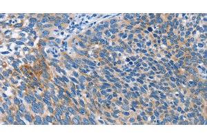 Immunohistochemistry of paraffin-embedded Human cervical cancer tissue using AHR Polyclonal Antibody at dilution 1:50 (Aryl Hydrocarbon Receptor Antikörper)