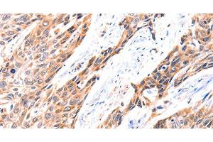 Immunohistochemistry of paraffin-embedded Human esophagus cancer using GNRHR Polyclonal Antibody at dilution of 1:117