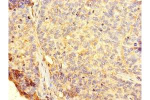 Immunohistochemistry of paraffin-embedded human ovarian cancer using ABIN7154641 at dilution of 1:100 (RHEBL1 Antikörper  (AA 1-180))