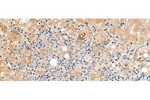 Immunohistochemistry of paraffin-embedded Human liver cancer tissue using MEST Polyclonal Antibody at dilution of 1:50(x200) (MEST Antikörper)