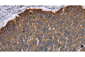 Immunohistochemistry of paraffin-embedded Human lung cancer using KRT31 Polyclonal Antibody at dilution of 1:30 (Keratin 31 Antikörper)