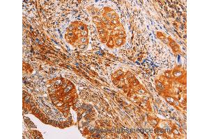 Immunohistochemistry of Human cervical cancer using SLC25A4 Polyclonal Antibody at dilution of 1:40 (SLC25A4 Antikörper)