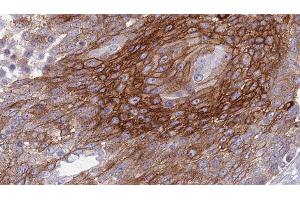 ABIN6277297 at 1/100 staining Human urothelial cancer tissue by IHC-P. (Betacellulin Antikörper  (N-Term))
