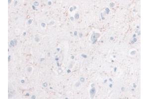 DAB staining on IHC-P; Samples: Human Glioma Tissue) (IL-10 Antikörper  (AA 1-178))