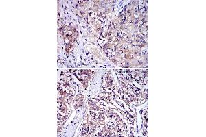 Immunohistochemical analysis of paraffin-embedded human lung cancer (A) and human kidney cancer tissues using IRAK4 monoclonal antibody, clone 2H9  with DAB staining.