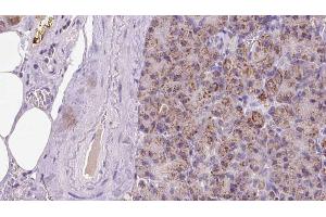ABIN6273287 at 1/100 staining Human pancreas cancer tissue by IHC-P. (Parvin, beta Antikörper  (C-Term))