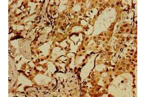 Immunohistochemistry of paraffin-embedded human breast cancer using ABIN7175658 at dilution of 1:100 (SORCS1 Antikörper  (AA 34-175))