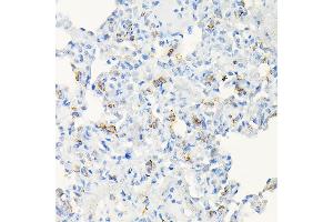 Immunohistochemistry of paraffin-embedded human colon carcinoma using  Rabbit pAb (ABIN6131167, ABIN6136429, ABIN6136430 and ABIN6216480) at dilution of 1:50 (40x lens). (ACE2 Antikörper  (AA 18-250))