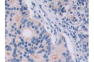 DAB staining on IHC-P; Samples: Human Prostate cancer Tissue (IL18R1 Antikörper  (AA 147-255))