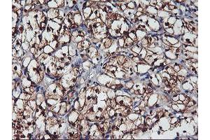 Immunohistochemical staining of paraffin-embedded Carcinoma of Human kidney tissue using anti-NNMT mouse monoclonal antibody.
