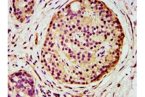 IHC image of ABIN7143720 diluted at 1:500 and staining in paraffin-embedded human pancreatic cancer performed on a Leica BondTM system. (AGPS Antikörper  (AA 279-400))