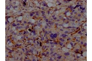 IHC image of ABIN7127322 diluted at 1:100 and staining in paraffin-embedded human liver cancer performed on a Leica BondTM system. (Rekombinanter ACVRL1 Antikörper)