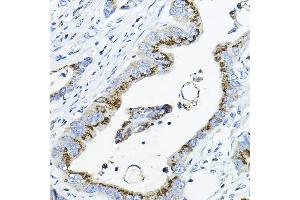 Immunohistochemistry of paraffin-embedded human colon carcinoma using G Rabbit pAb (ABIN6131444, ABIN6140942, ABIN6140944 and ABIN6218180) at dilution of 1:100 (40x lens). (GALNT3 Antikörper  (AA 1-140))