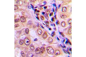 Immunohistochemical analysis of MEKK4 staining in human breast cancer formalin fixed paraffin embedded tissue section. (MAP3K4 Antikörper  (C-Term))