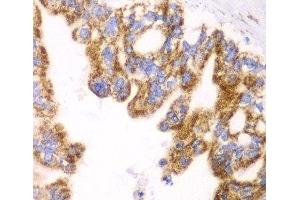 Immunohistochemistry of paraffin-embedded Human liver cancer using GLUD2 Polyclonal Antibody at dilution of 1:100 (40x lens). (GLUD2 Antikörper)