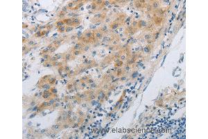 Immunohistochemistry of Human liver cancer using GJB6 Polyclonal Antibody at dilution of 1:30
