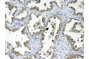 IHC testing of FFPE human lung cancer tissue with DYNLT1 antibody at 1ug/ml.