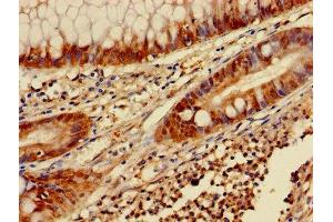 Immunohistochemistry of paraffin-embedded human colon cancer using ABIN7153453 at dilution of 1:100 (Galectin 3 Antikörper  (AA 2-250))