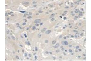 IHC-P analysis of Human Esophagus Cancer Tissue, with DAB staining. (ANTXR2 Antikörper  (AA 34-318))