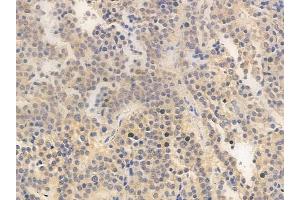 ABIN6263785 and ABIN6266653 at 1/100 staining human pituitary adenoma by IHC-P. (NUB1 Antikörper  (C-Term))