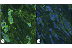 Immunohistochemistry image of Thymosin ß4 staining in paraffn sections of breast cancer tissue. (TMSB4X Antikörper  (AA 1-14))