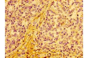 IHC image of ABIN7149142 diluted at 1:100 and staining in paraffin-embedded human colon cancer performed on a Leica BondTM system. (COX15 Antikörper  (AA 1-67))