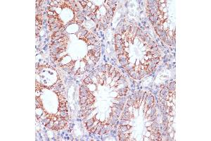 Immunohistochemistry of paraffin-embedded human colon carcinoma using HIGD1A antibody (ABIN7267642) at dilution of 1:100 (40x lens).