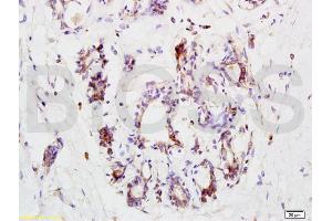 Formalin-fixed and paraffin embedded human breast carcinoma labeled with Anti-CCR3 Polyclonal Antibody, Unconjugated (ABIN738651) at 1:200 followed by conjugation to the secondary antibody and DAB staining. (CCR3 Antikörper  (AA 251-355))