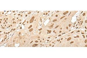 Immunohistochemistry of paraffin-embedded Human esophagus cancer tissue using ZNF274 Polyclonal Antibody at dilution of 1:35(x200) (ZNF274 Antikörper)