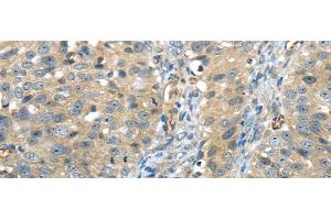 Immunohistochemistry of paraffin-embedded Human breast cancer using ISM2 Polyclonal Antibody at dilution of 1/45
