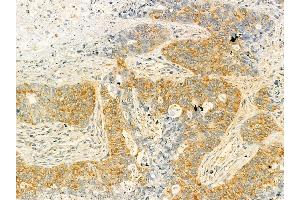 HDLBP Mouse Monoclonal Antibody at 1/100 staining human lung cancer and adjacent non-tumor tissue by IHC-P.