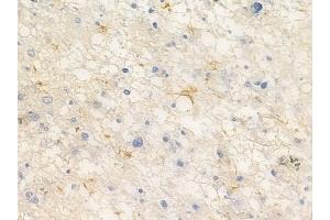 ABIN6265335 and ABIN6266873 at 1/100 staining human astrocytoma by IHC-P.