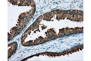 Immunohistochemical staining of paraffin-embedded Carcinoma of liver tissue using anti-RDH11 mouse monoclonal antibody.