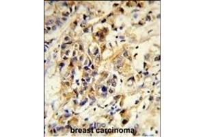 Formalin-fixed and paraffin-embedded human breast carcinoma reacted with RPGRIP1 Antibody (Center), which was peroxidase-conjugated to the secondary antibody, followed by DAB staining. (RPGRIP1 Antikörper  (AA 530-557))