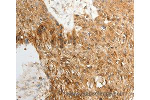 Immunohistochemistry of Human ovarian cancer using TENM3 Polyclonal Antibody at dilution of 1:50 (TENM3 Antikörper)